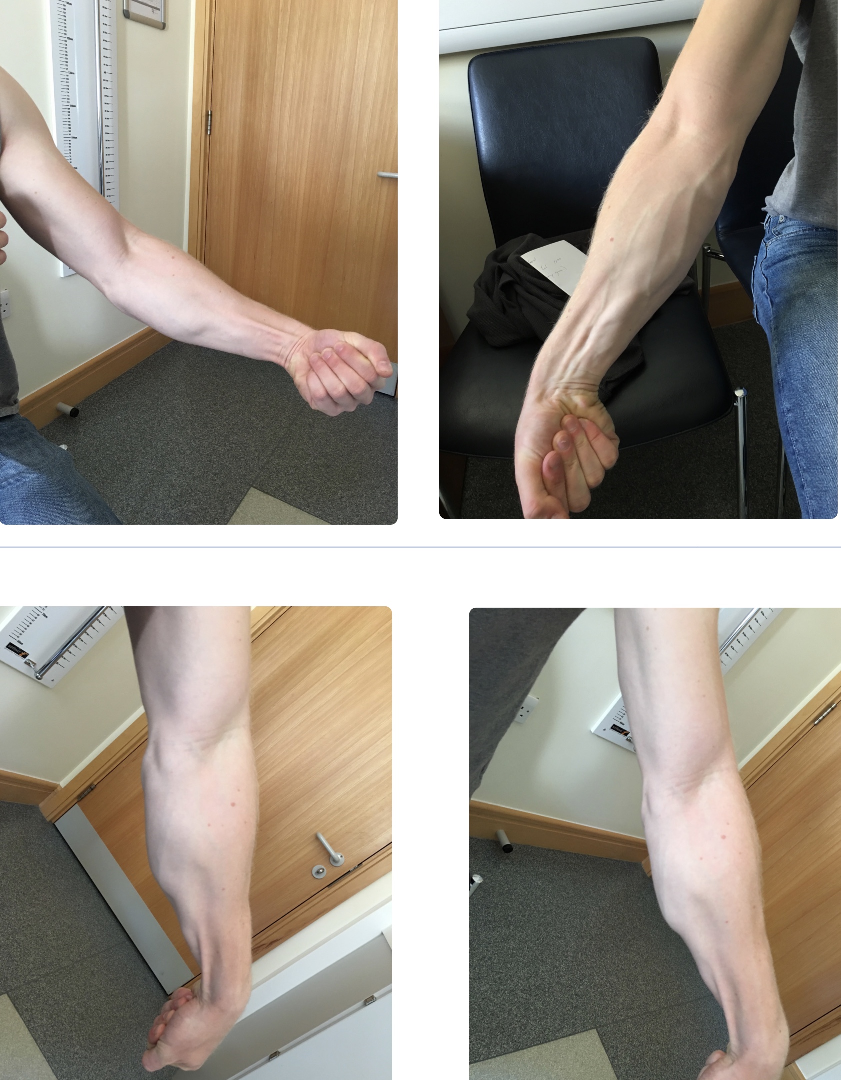 Arm Pump (Chronic Exertional Compartment Syndrome) Shamim Umarji